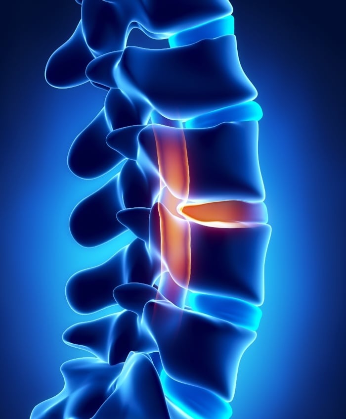 Sacral Spine (S1 S5) Injuries, Sacral Sparing